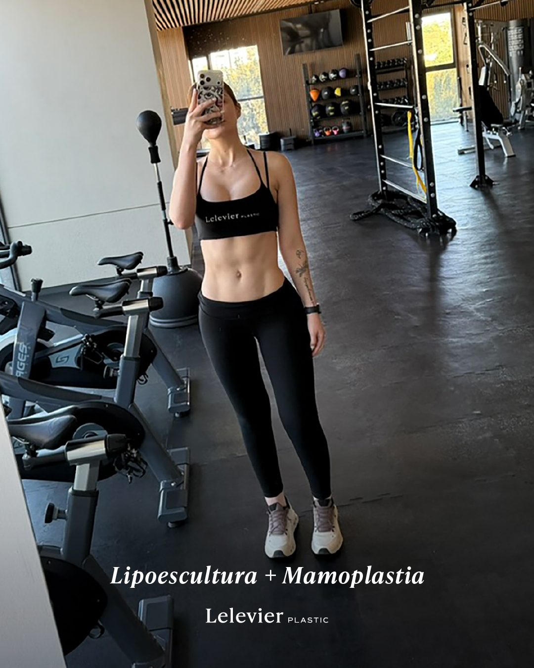 Resultado de lipoescultura y mamoplastia